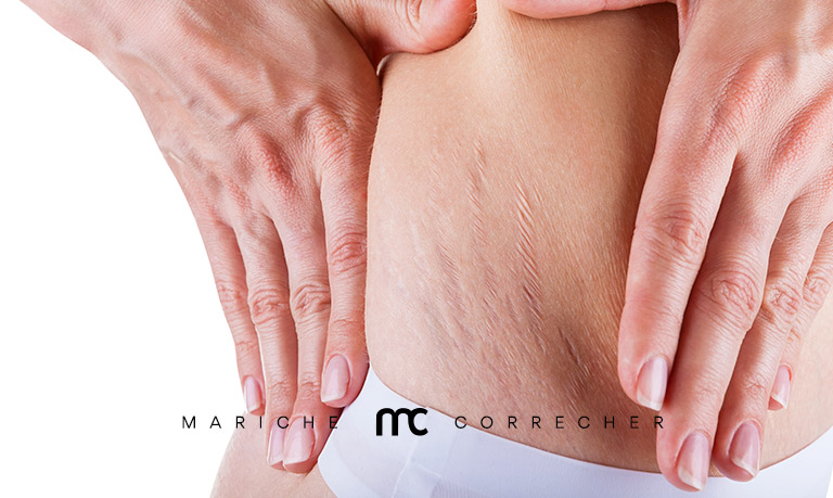 como quitar las estrias - mariche correcher